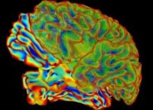 Sumalateral whole brain image courtesy: flickr
