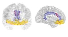 A web graphic with a white background contains an image of a front view brain scan (left) and a side view brain scan (right)