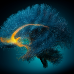a human brain showing 3D white matter structure (blue-dark blue) and a targeted region (yellow-orange) for deep brain stimulation